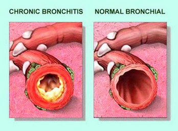 chronic-bronchitis-vs-normal-bronchial