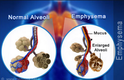 normal-alveoli-vs-emphysema